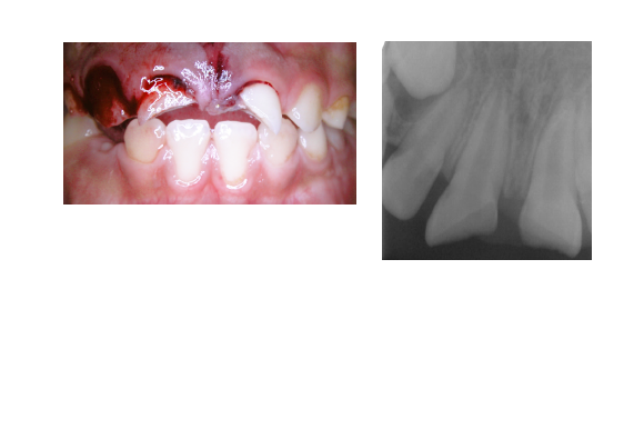 Fracture amélo-dentinaire compliquée