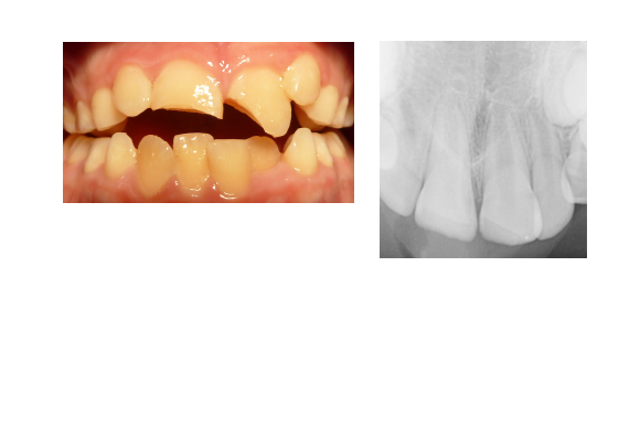 Fracture Amélo-dentinaire simple